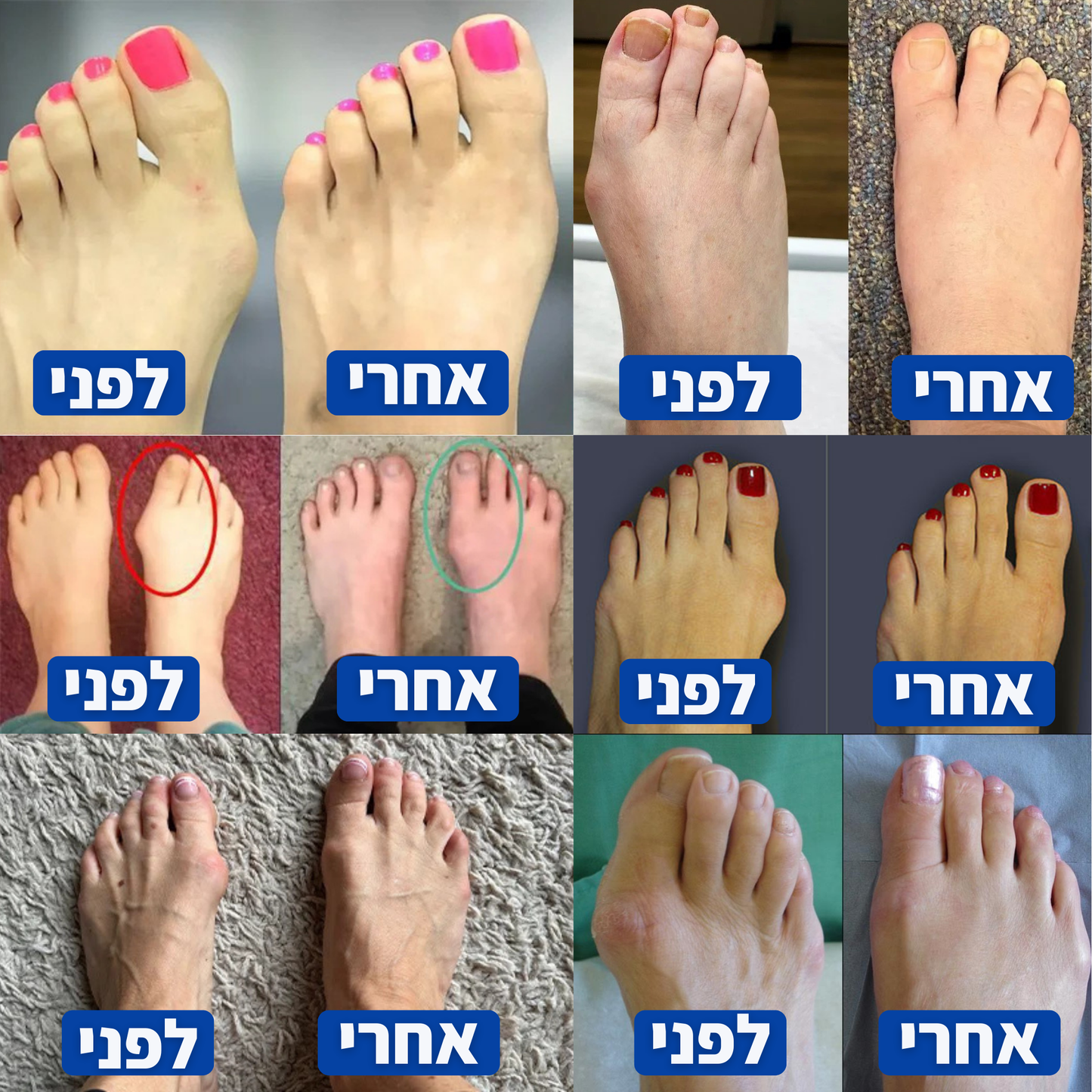 Bunion+ סד יישור לבוהן קלובה